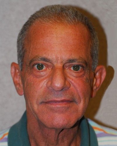 Liquid Facelift Before & After