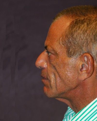 Liquid Facelift Before & After