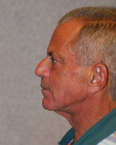 Liquid Facelift Before & After