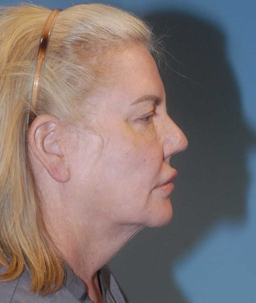 Fat Grafting Before & After