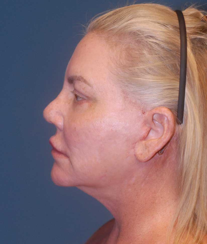 Fat Grafting Before & After