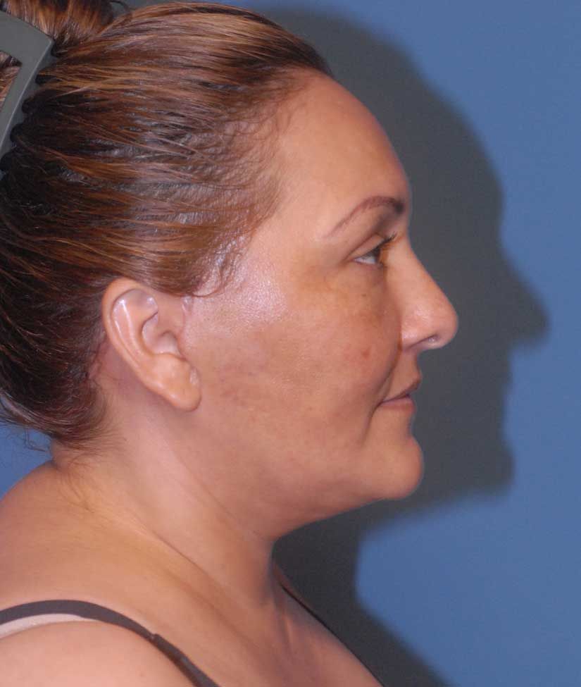 Fat Grafting Before & After