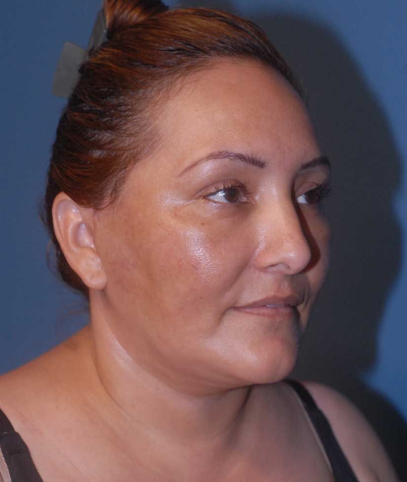 Fat Grafting Before & After