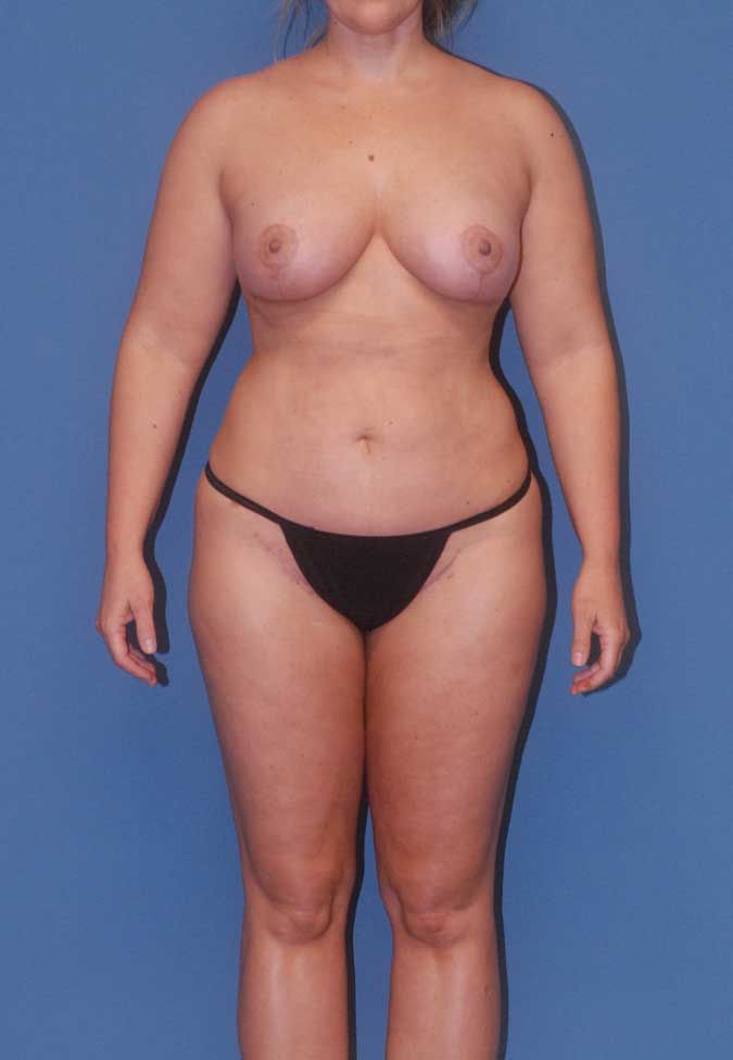 Thigh Lift Before & After