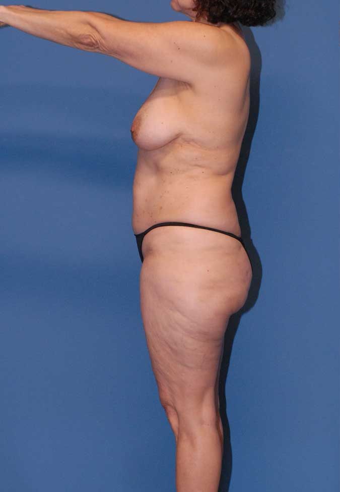 Thigh Lift Before & After