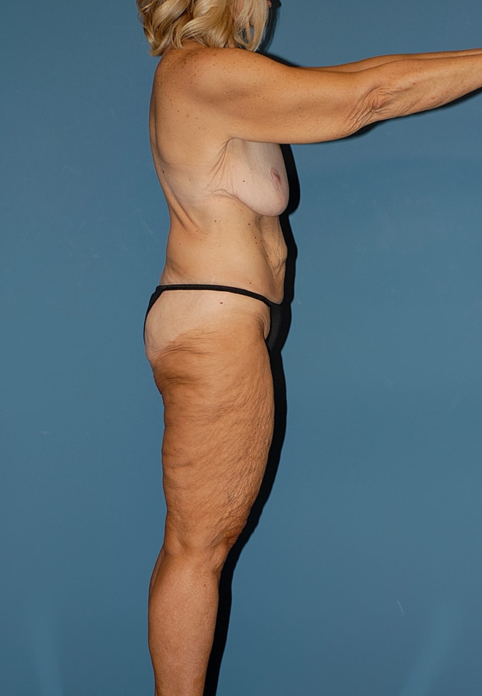 Thigh Lift Before & After