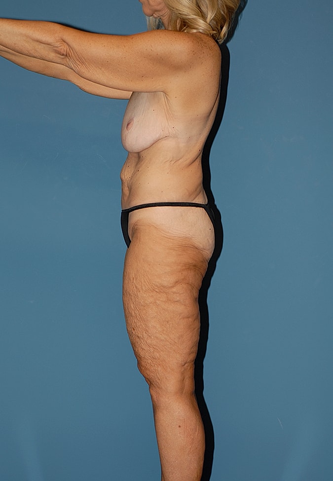 Thigh Lift Before & After