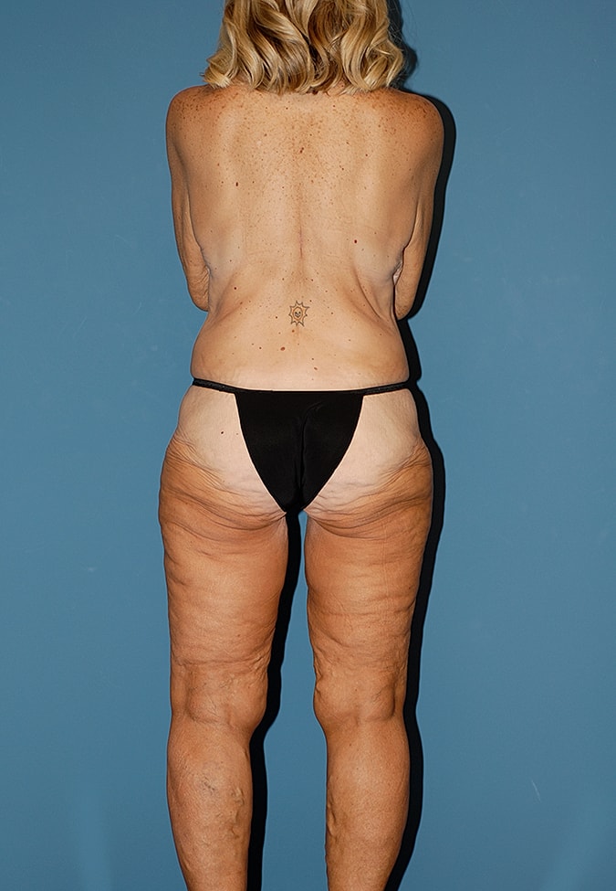 Thigh Lift Before & After