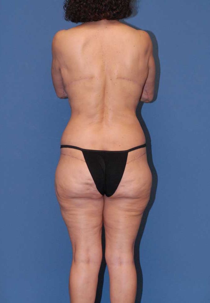 Lower Body Lift And Back Lift Before & After