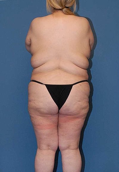 Lower Body Lift And Back Lift Before & After