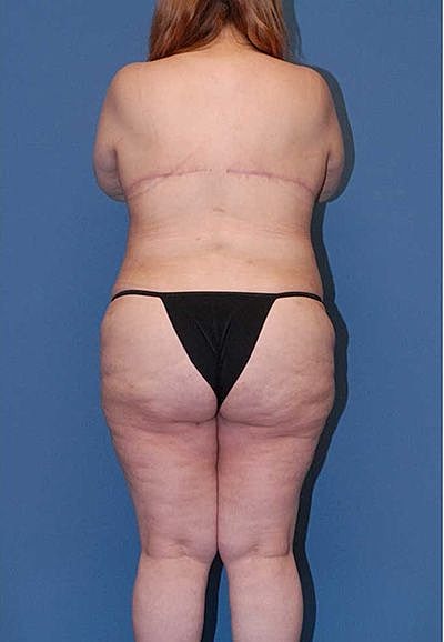 Lower Body Lift And Back Lift Before & After