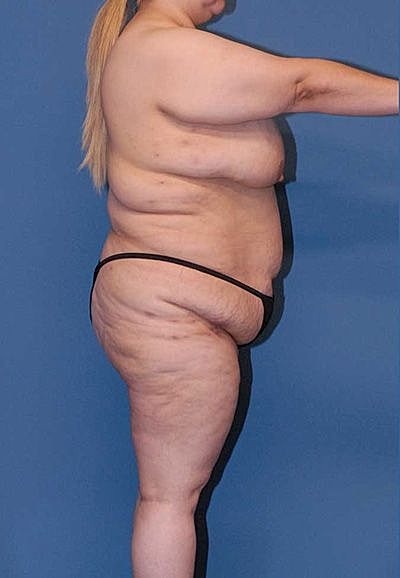 Lower Body Lift And Back Lift Before & After