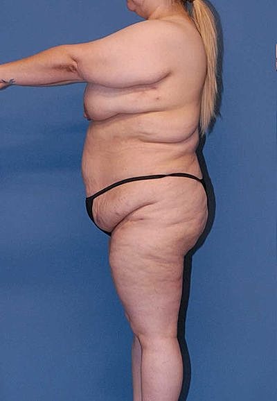 Lower Body Lift And Back Lift Before & After