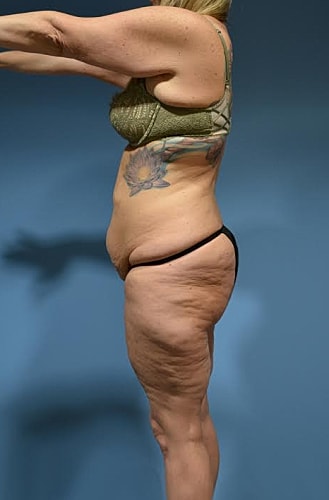 Post Weight Loss Surgery Before & After