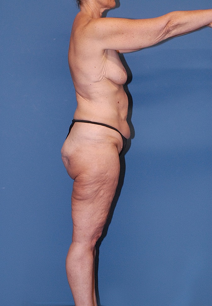 Post Weight Loss Surgery Before & After