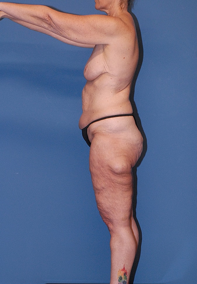 Post Weight Loss Surgery Before & After