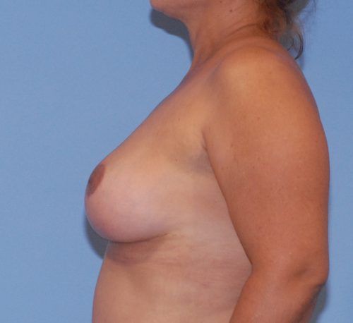 Breast Lift Before & After