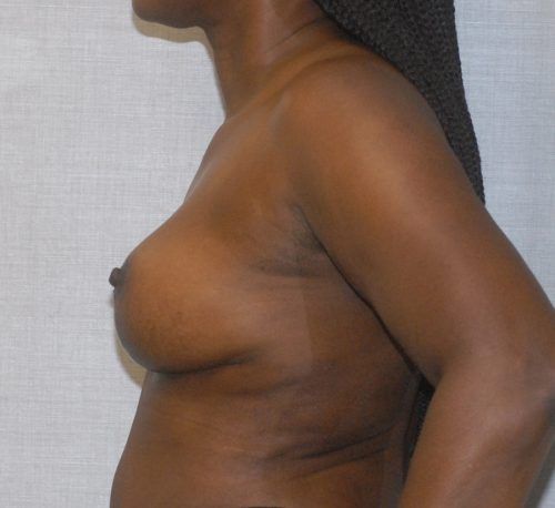 Breast Lift Before & After