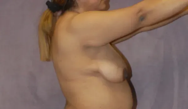 Breast Lift Before & After