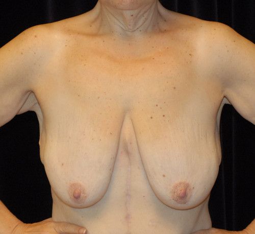Breast Lift Before & After