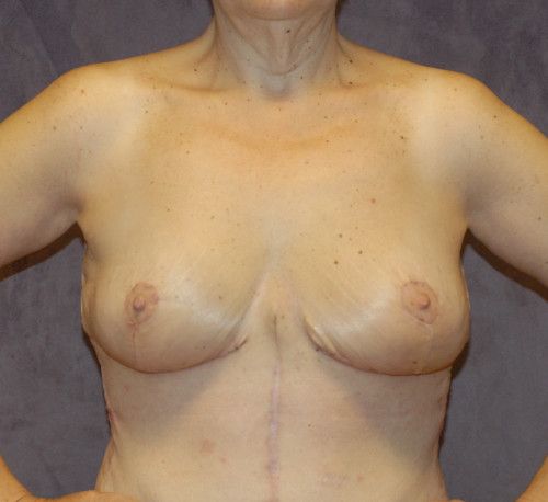 Breast Lift Before & After