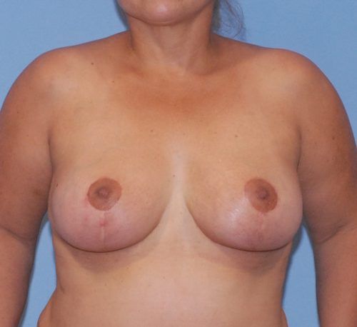 Breast Lift Before & After