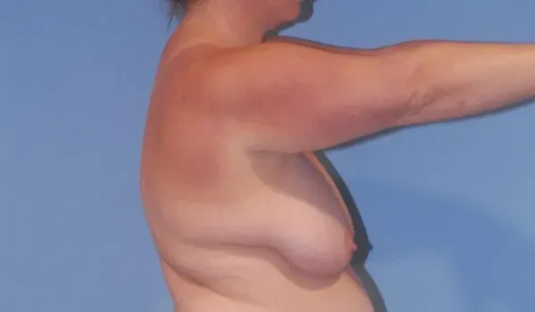 Breast Lift Before & After