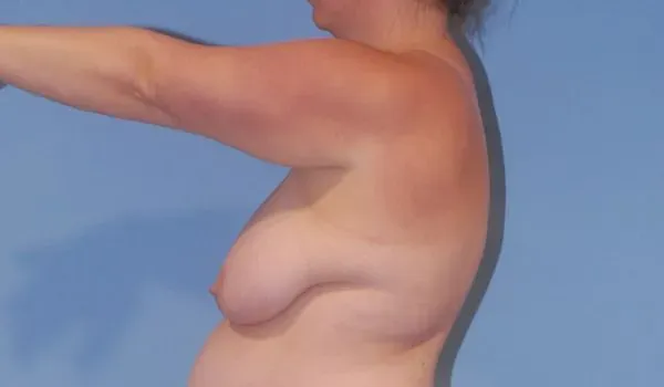 Breast Lift Before & After