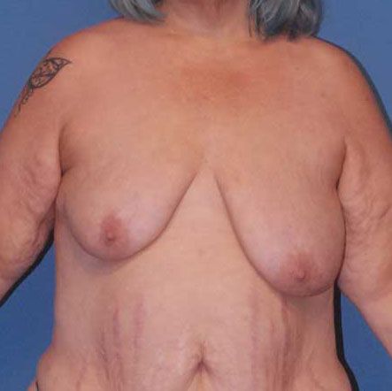 Breast Lift Before & After