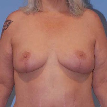 Breast Lift Before & After