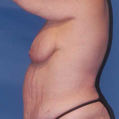 Breast Lift Before & After