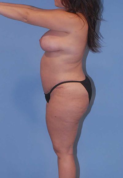 Breast Lift Before & After