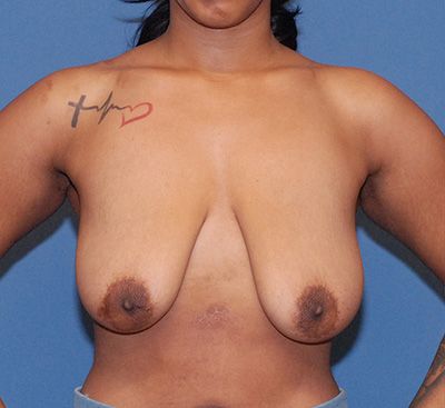 Breast Lift Before & After