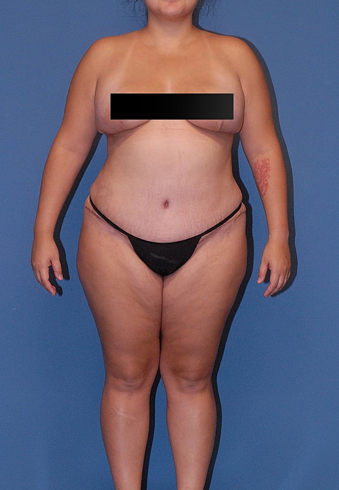 Breast Lift Before & After