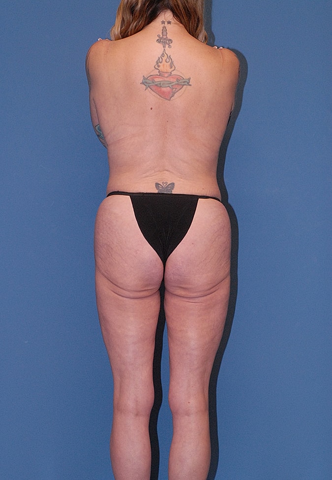 Breast Lift Before & After