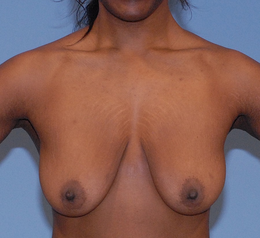 Breast Lift Before & After