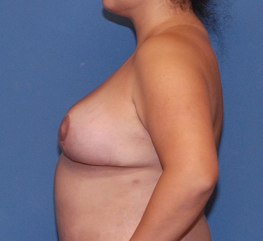 Breast Lift Before & After