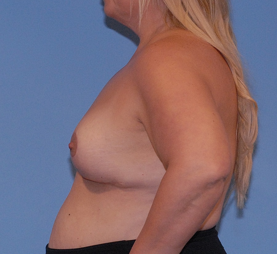 Breast Lift Before & After
