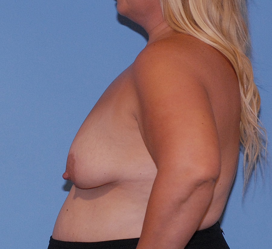 Breast Lift Before & After