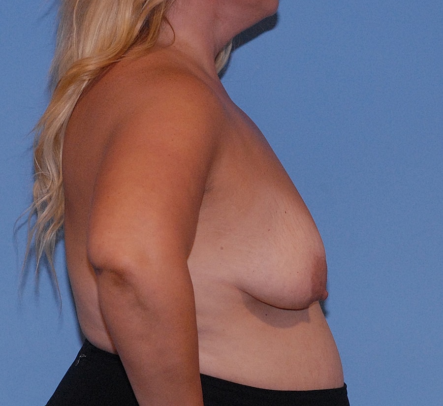 Breast Lift Before & After