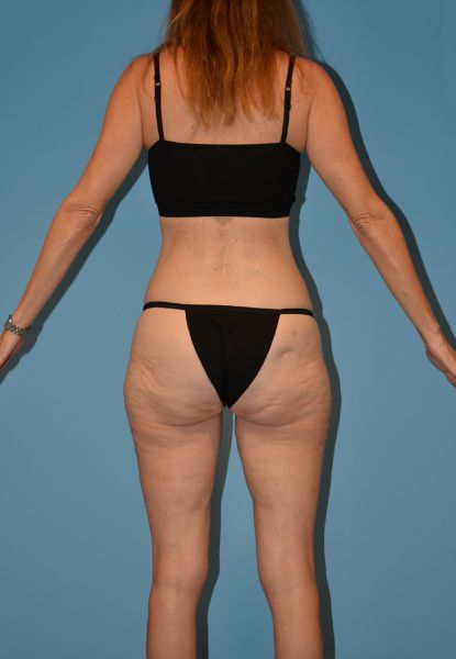 Body Lift Before & After