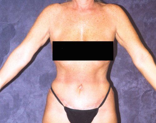 Body Lift Before & After