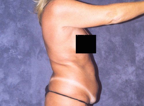 Body Lift Before & After