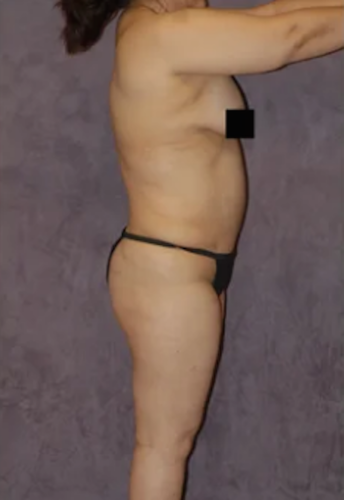 Body Lift Before & After