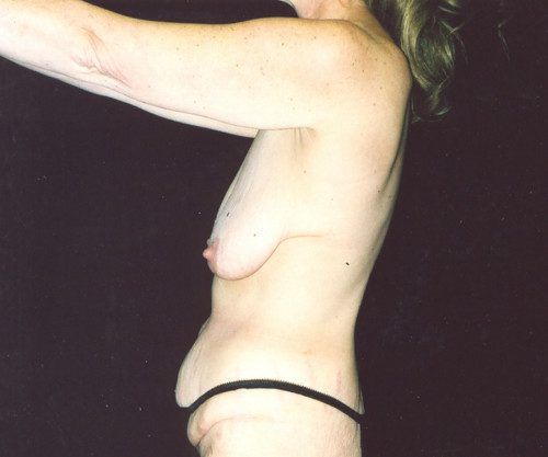 Body Lift Before & After