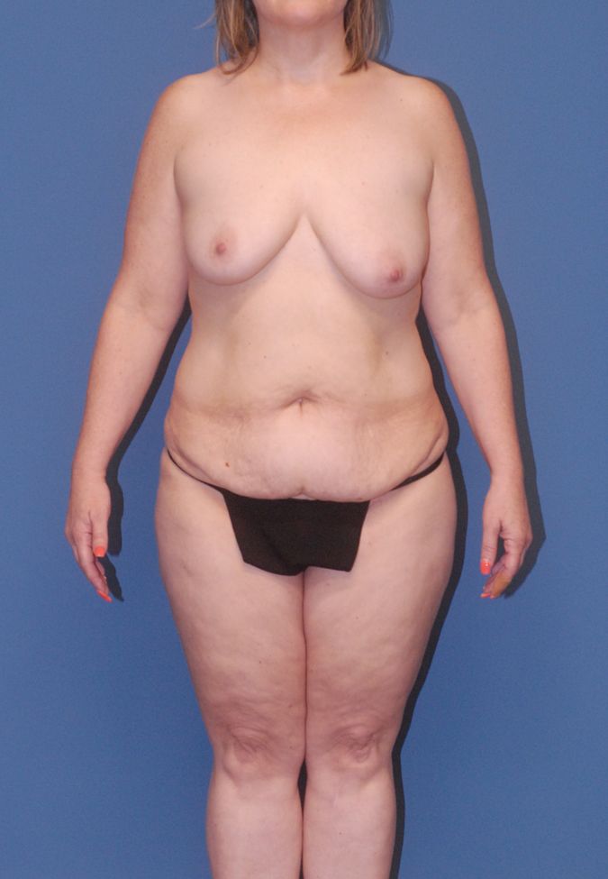 Body Lift Before & After