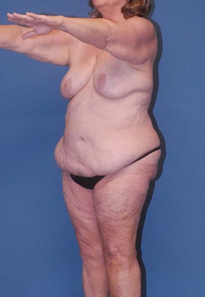 Body Lift Before & After