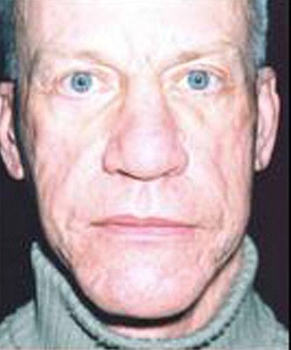 Male Facial Rejuvenation Before & After