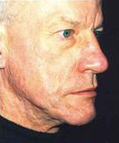 Male Facial Rejuvenation Before & After