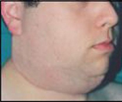 Male Facial Rejuvenation Before & After